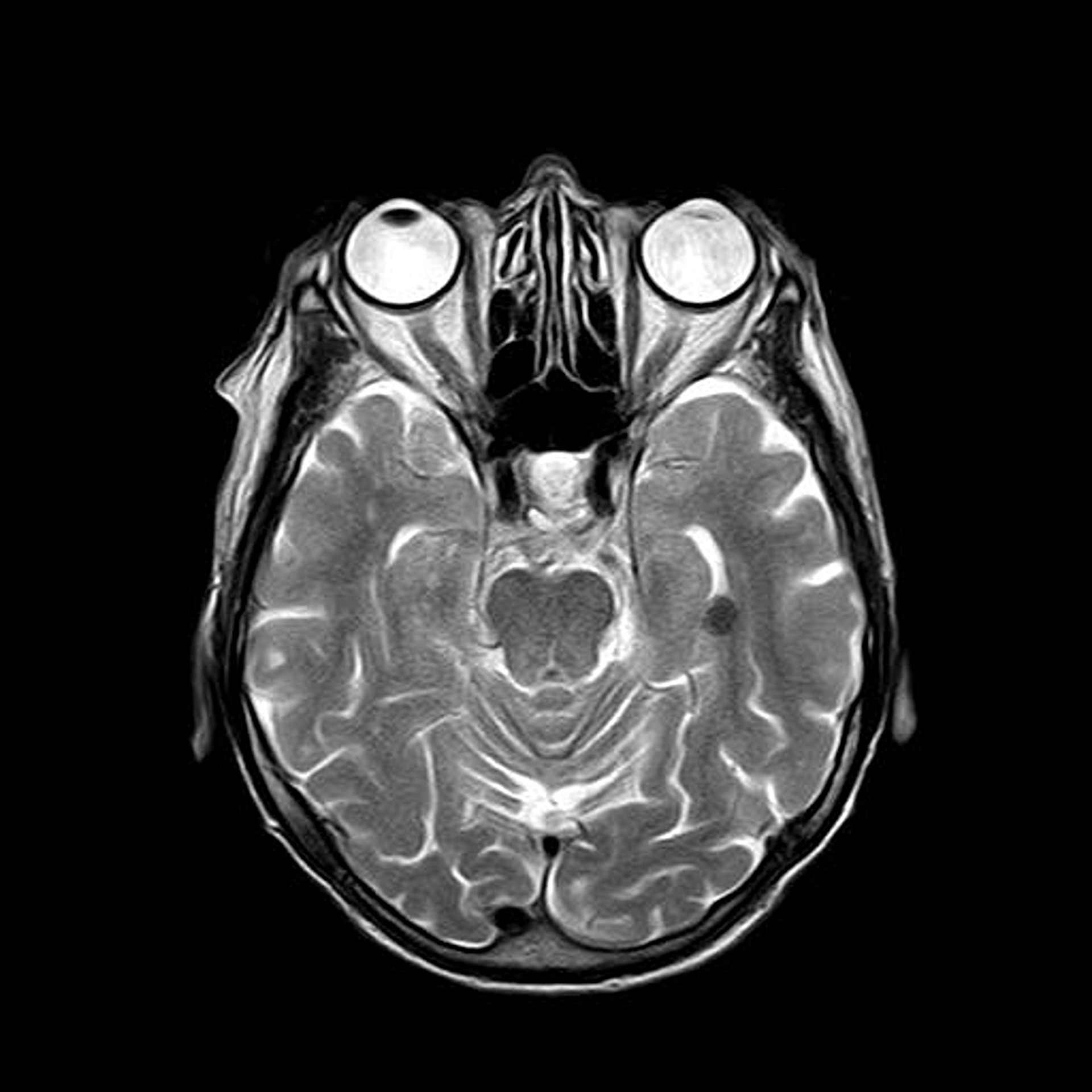 MRI photo of skull and internal parts.